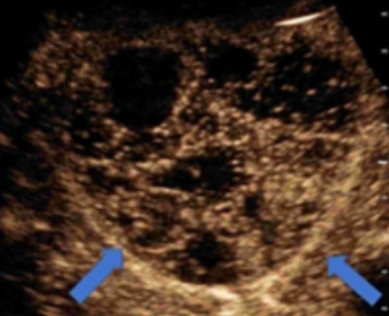 Retroperitoneal Ewing's sarcoma in a woman with advanced breast cancer delineated by contrast-enhanced ultrasound